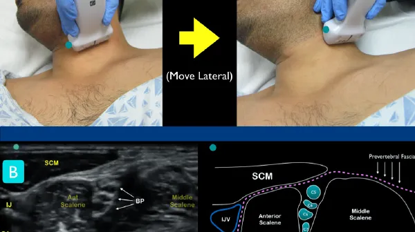 Ultrasound-guided interscalene block technique