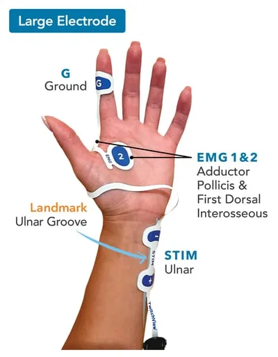 TOF monitor placement on ulnar nerve at wrist