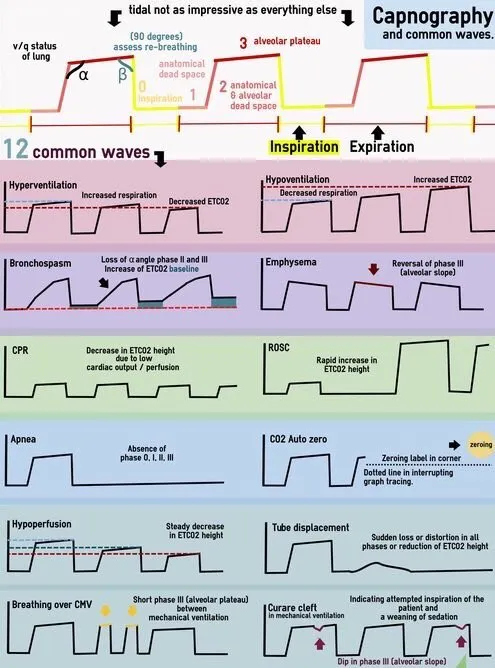 Capnography Waveforms: Normal and Abnormal Patterns