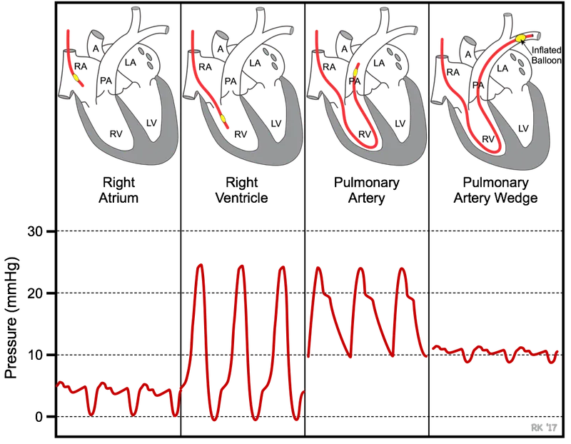 PA Catheter Insertion and Pressure Waveforms