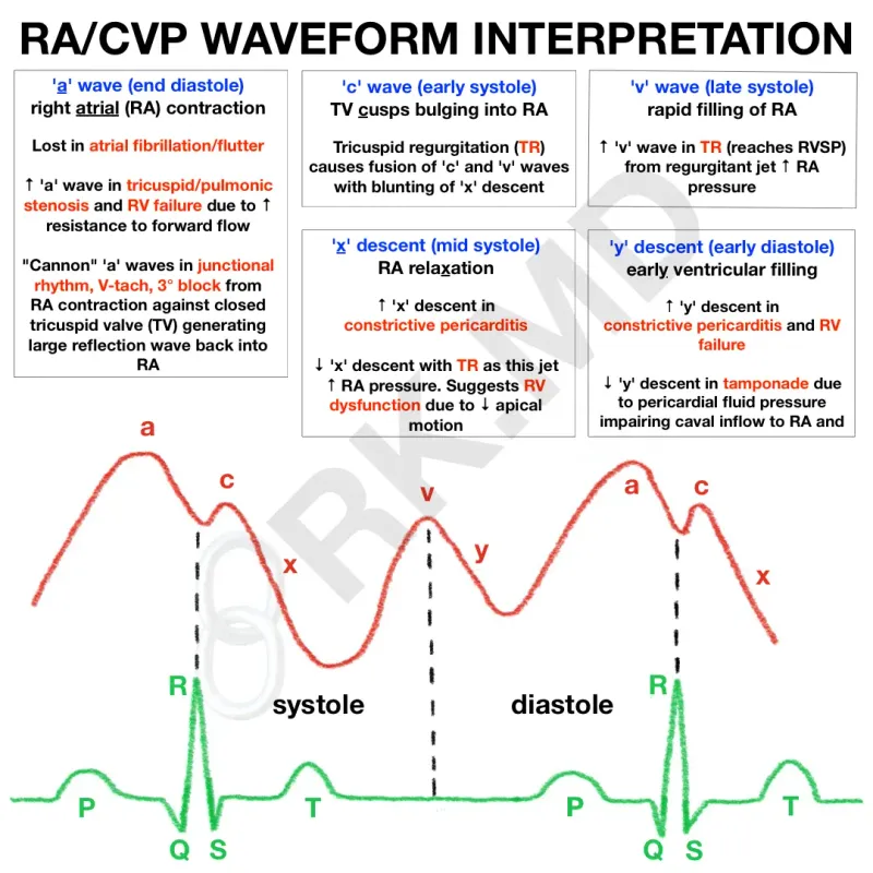 RA/CVP Waveform Interpretation with ECG Correlation