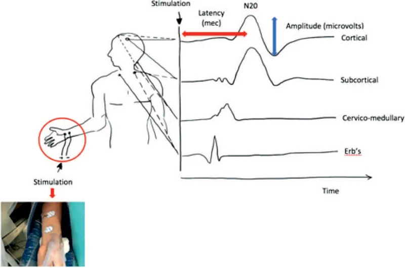 SSEP waveform diagram