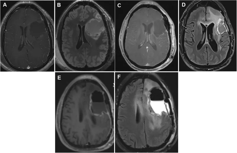 Brain MRI: Tumor Before and After Craniotomy