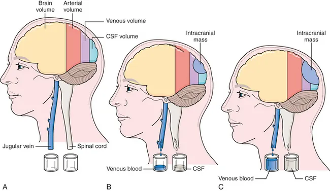 Monro-Kellie doctrine and intracranial mass effect