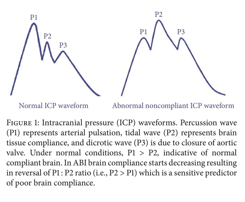 Normal vs. Abnormal Noncompliant ICP Waveforms