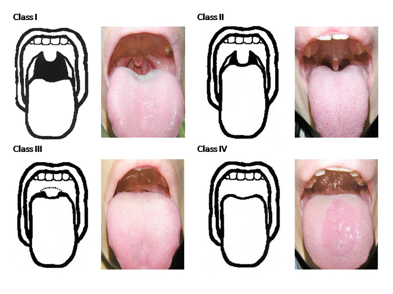 Mallampati Airway Classification