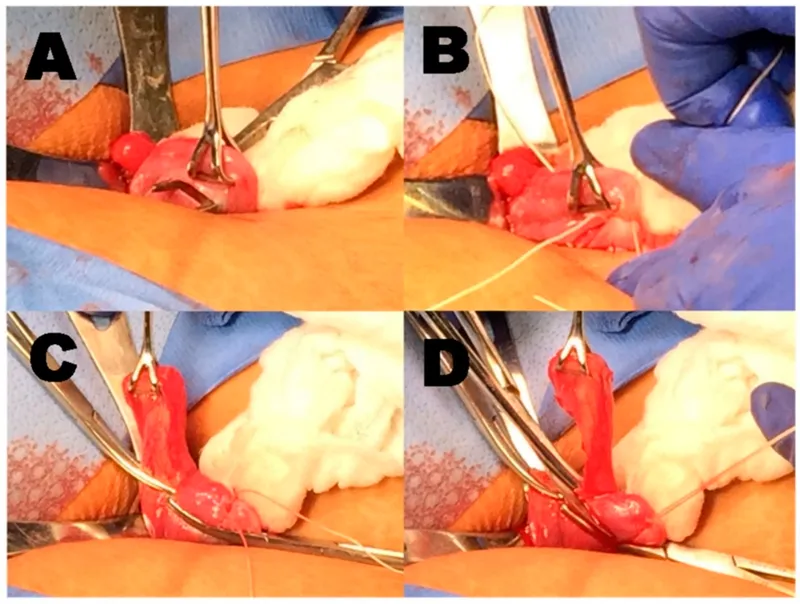 Postpartum Tubal Ligation Procedure Steps