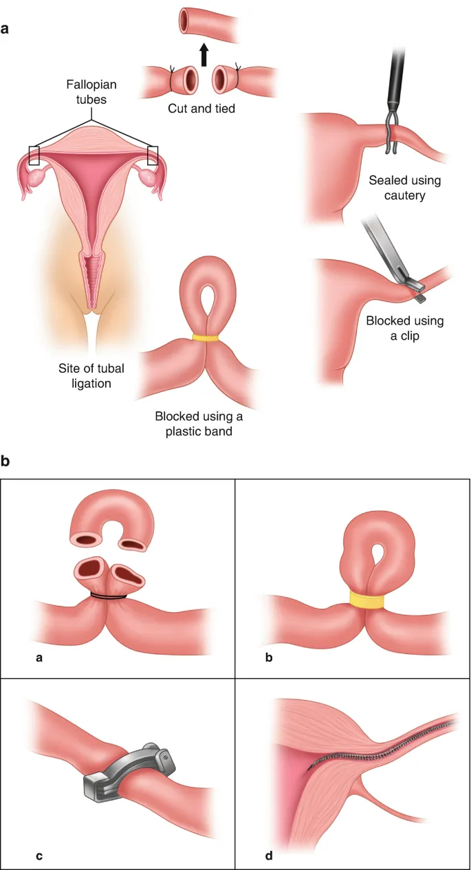 Tubal Ligation Methods