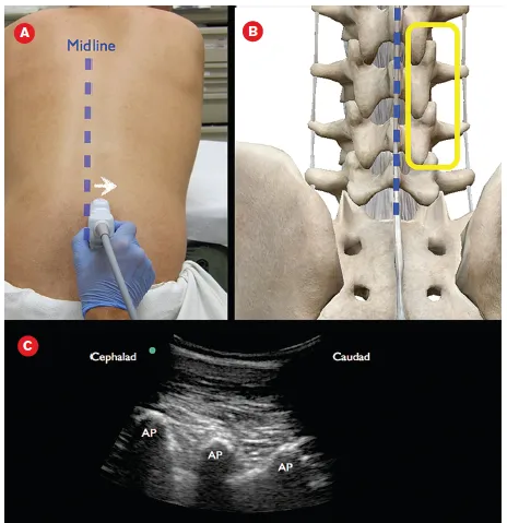 Ultrasound-guided lumbar spine interventional procedure