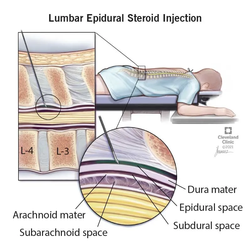 Lumbar Epidural Steroid Injection Diagram