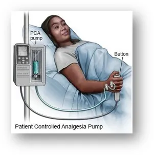 Patient-Controlled Analgesia (PCA) Pump
