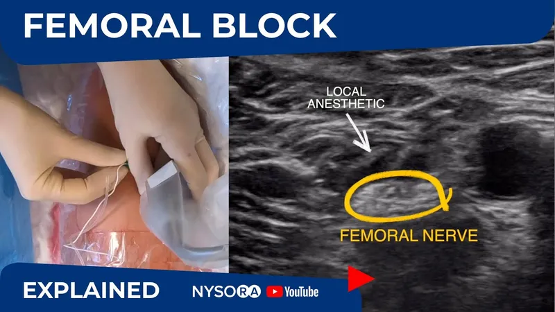 USG-guided Femoral Nerve Block