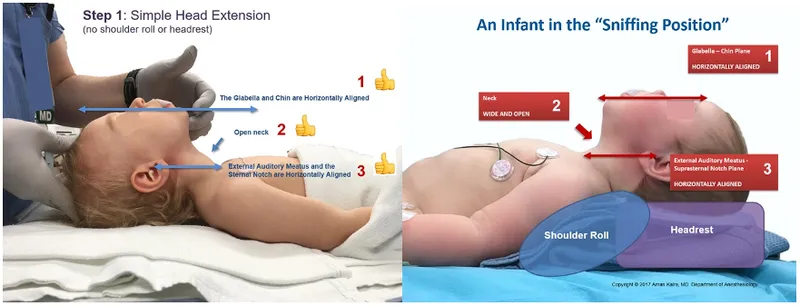 Infant airway positioning: Simple vs sniffing