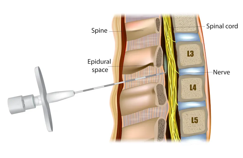 Epidural space anatomy and needle placement