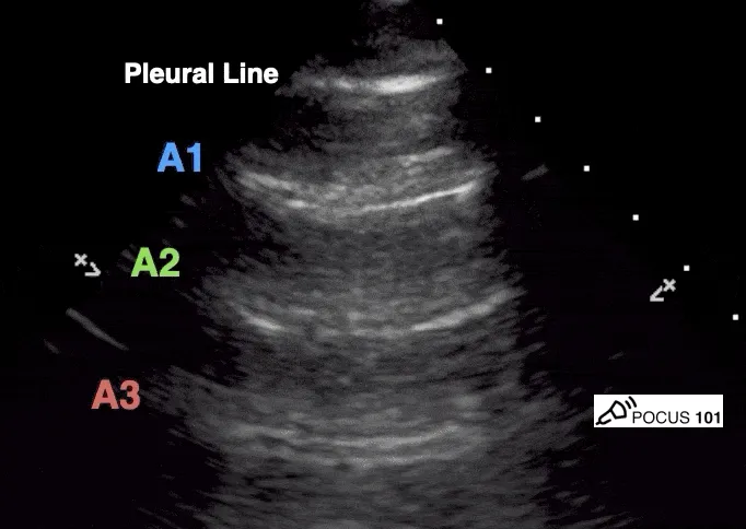 Lung Ultrasound: A-lines, B-lines, Pleural Line