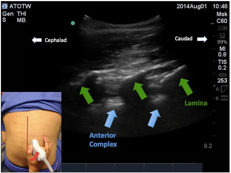 Ultrasound Sagittal Paramedian View Lumbar Spine