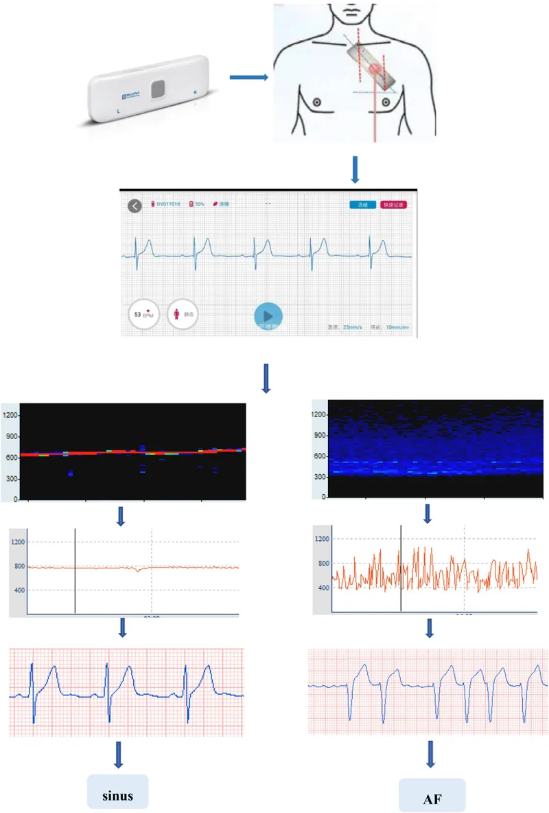 ECG showing sinus rhythm and atrial fibrillation
