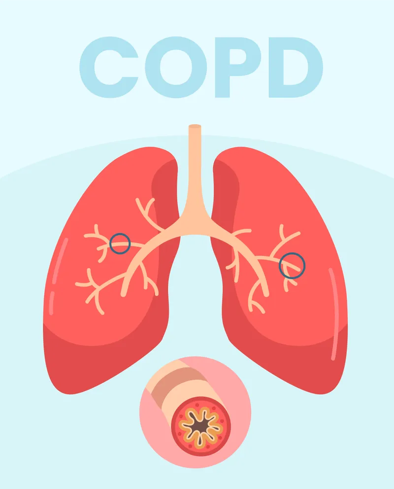 COPD Lungs Diagram