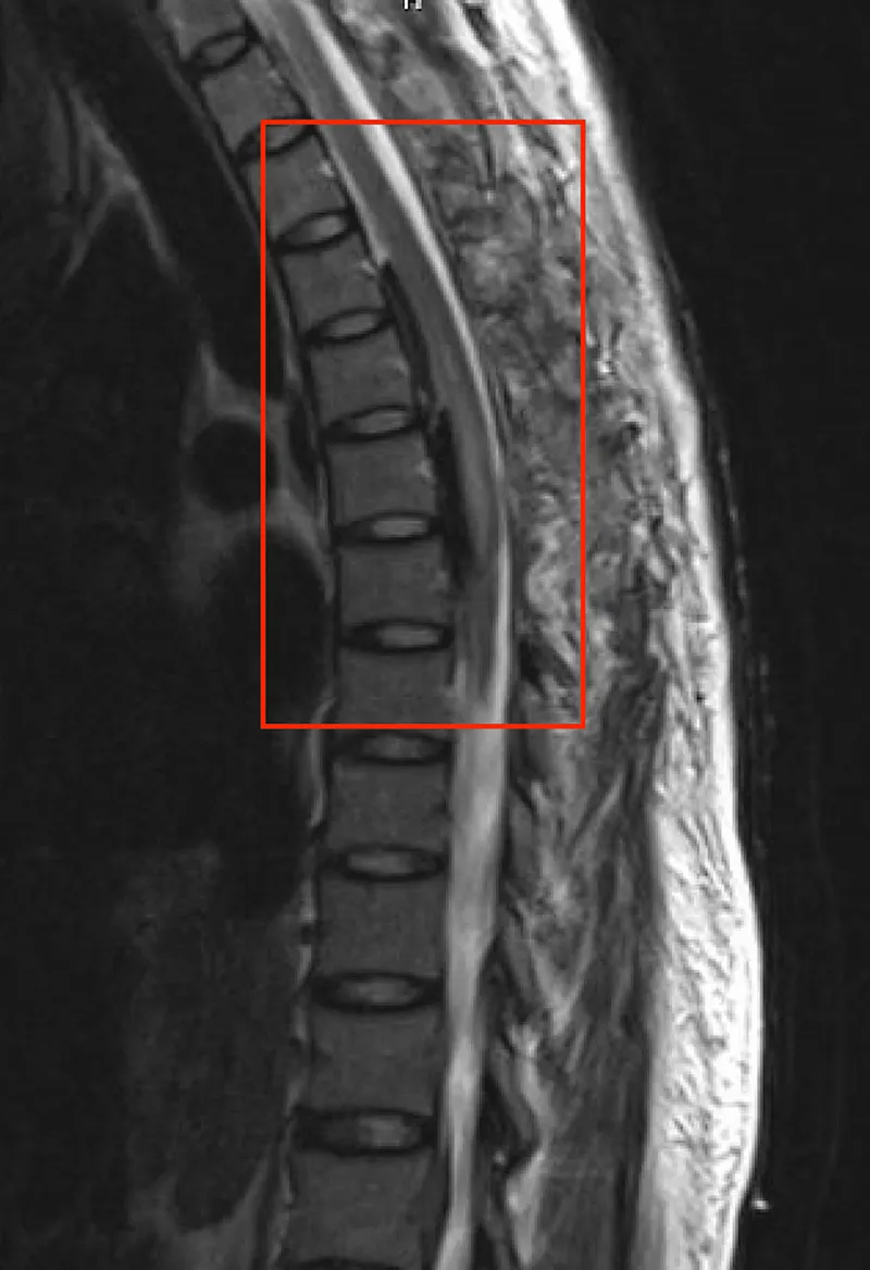 MRI: Epidural Hematoma vs. Epidural Abscess