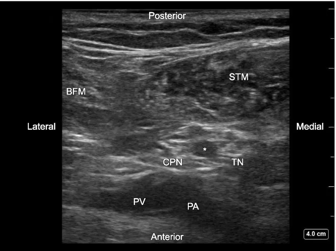 Ultrasound of sciatic nerve bifurcation