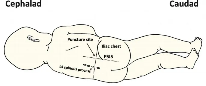 Spinal Anesthesia Puncture Site and Landmarks