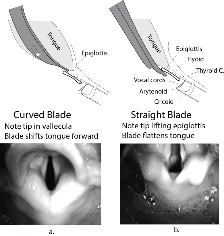 Curved vs Straight Laryngoscope Blade Technique