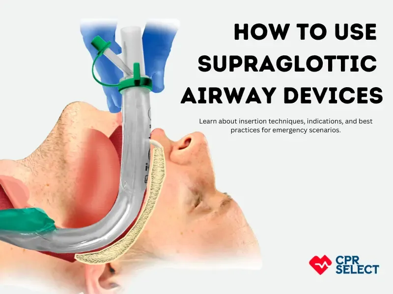 Supraglottic Airway Device Insertion Illustration