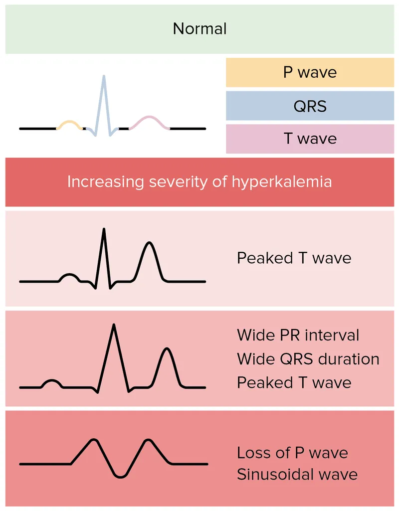 ECG changes in hyperkalemia