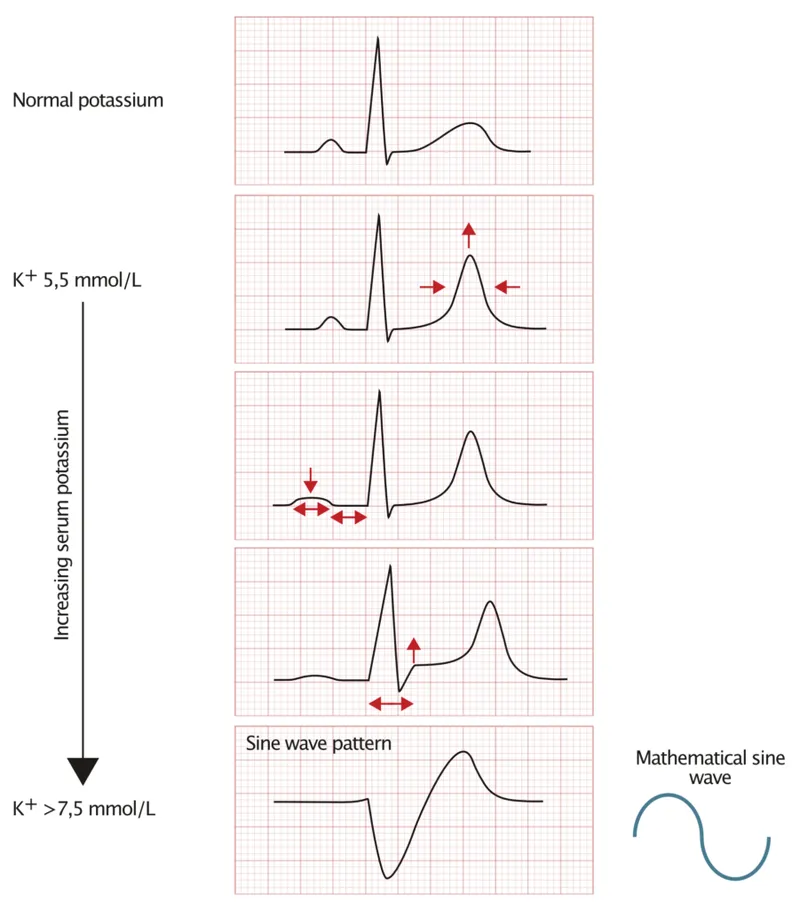 ECG changes with increasing serum potassium levels