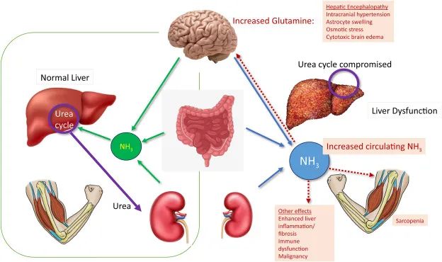 Hyperammonemia effects on brain in urea cycle disorders