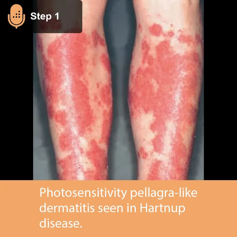 Pellagra-like rash in Hartnup disease