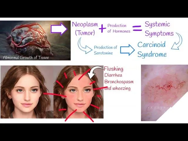 Carcinoid Syndrome: Symptoms and Serotonin Production