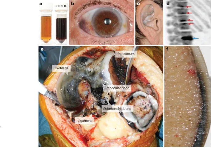 Alkaptonuria: Clinical and Pathological Manifestations