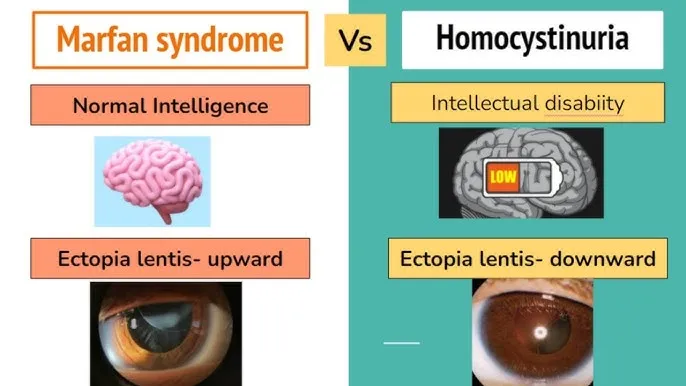 Homocystinuria vs. Marfan Syndrome: Key Differences