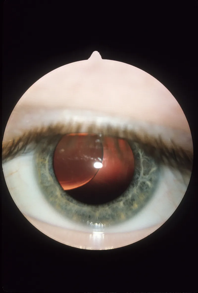Ectopia lentis in homocystinuria