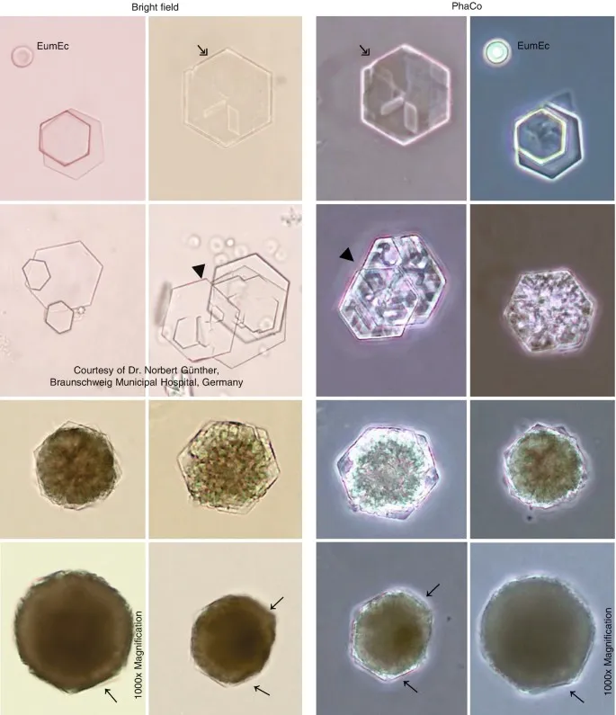 Hexagonal cystine crystals in urine sediment