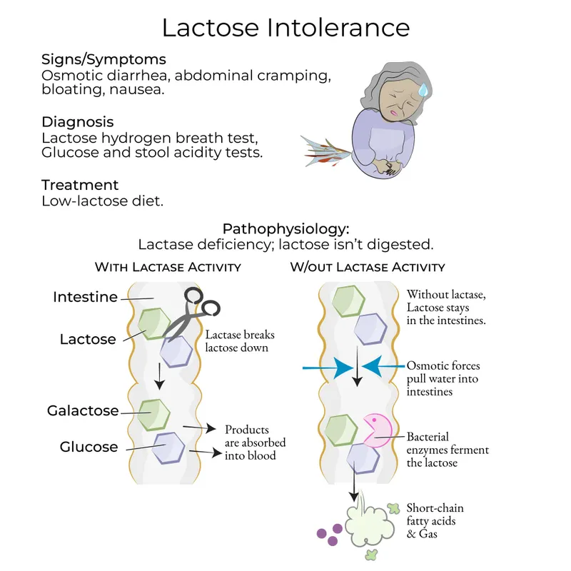 Lactose Intolerance Pathophysiology