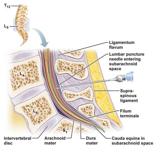 Lumbar Puncture Needle Insertion and Spinal Anatomy
