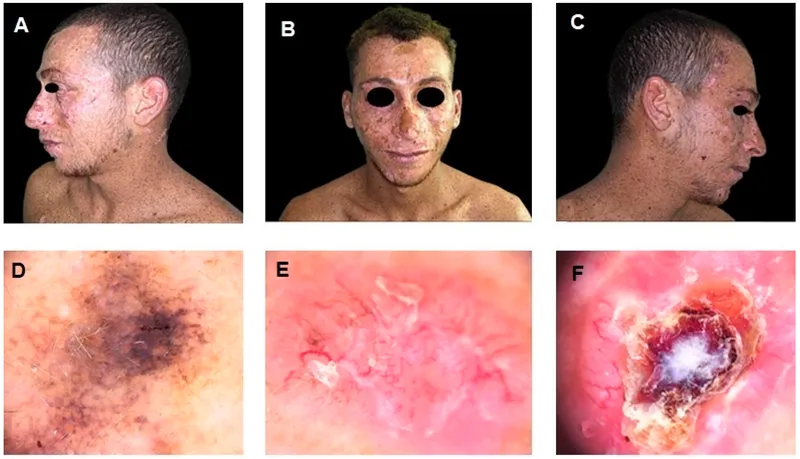 Xeroderma Pigmentosum: Freckling, skin tumors, and close-ups