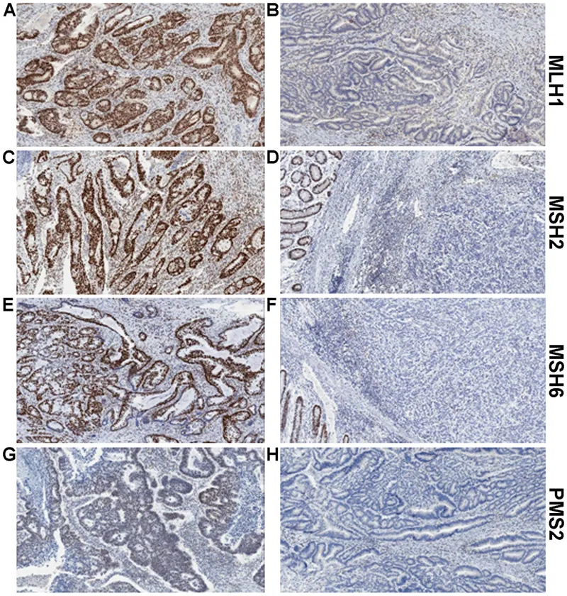 IHC staining of MLH1, MSH2, MSH6, PMS2 in colon cancer