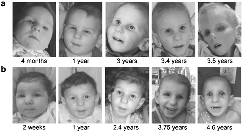 Progression of Cockayne Syndrome