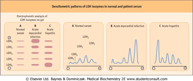 LDH isoenzyme patterns in normal serum, MI, and hepatitis