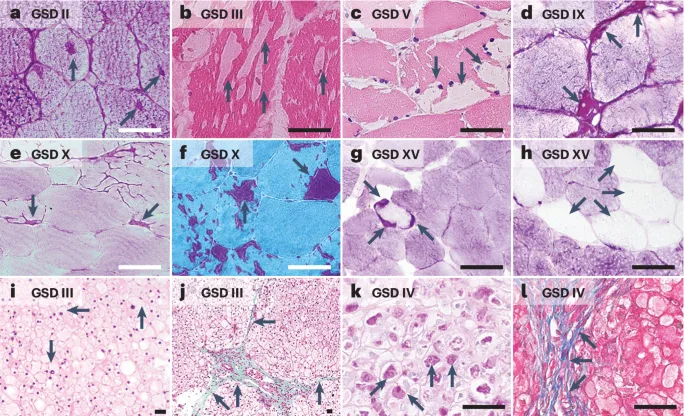 Glycogen Storage Diseases: Liver and Muscle Pathology
