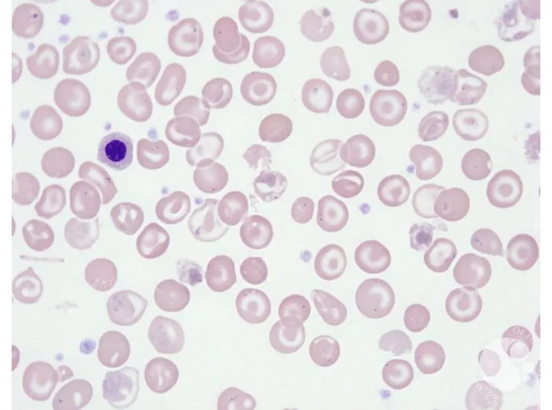 Thalassemia peripheral blood smear