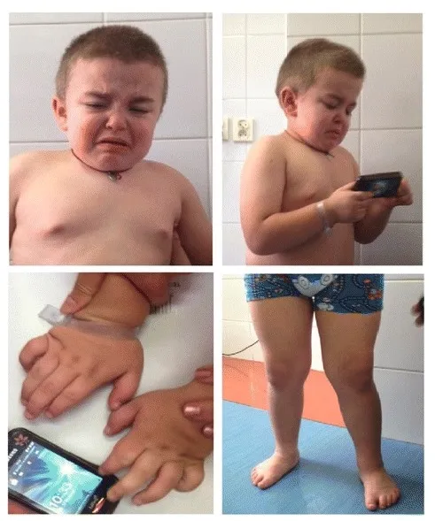 Mucopolysaccharidosis patient features