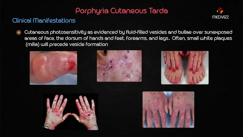 Porphyria Cutanea Tarda Clinical Manifestations