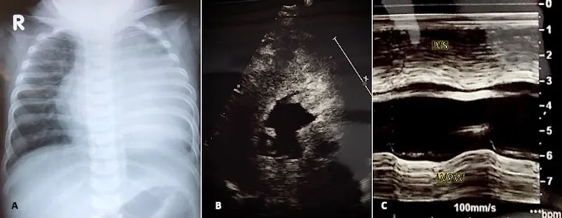 Infant chest X-ray and echo showing cardiomegaly