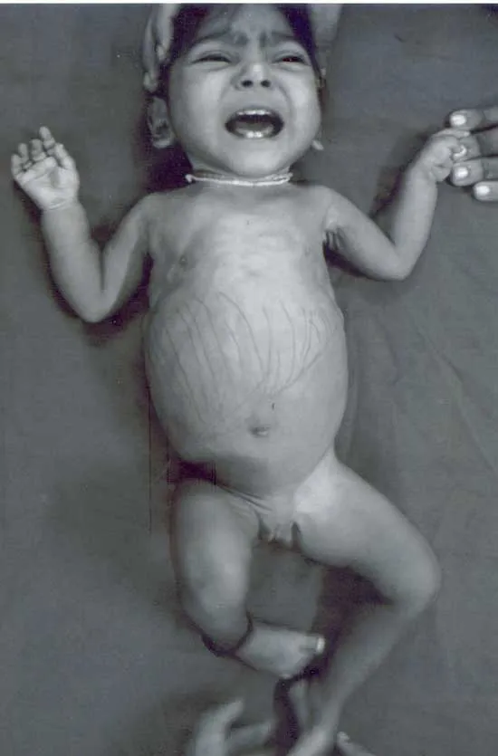 Child with hepatomegaly and doll-like facies in GSD