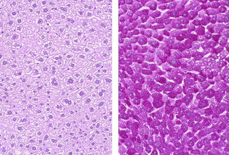 PAS stain with and without diastase in liver biopsy