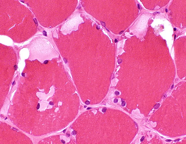 Muscle biopsy: subsarcolemmal glycogen in McArdle disease